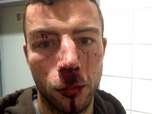 Hokejista Michal Hlinka byl napaden. Skončil s otřesem mozku a zlomeným nosem v nemocnici